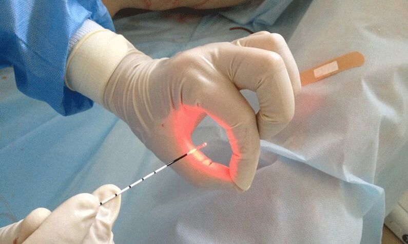 lasersko liječenje prostatitisa